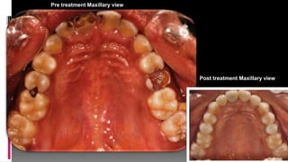 19
Pre treatment Maxillary view
Post treatment Maxillary view
 