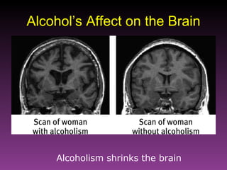 Alcohol’s Affect on the Brain Alcoholism shrinks the brain   