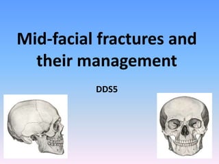 Mid-facial fractures and
their management
DDS5
 