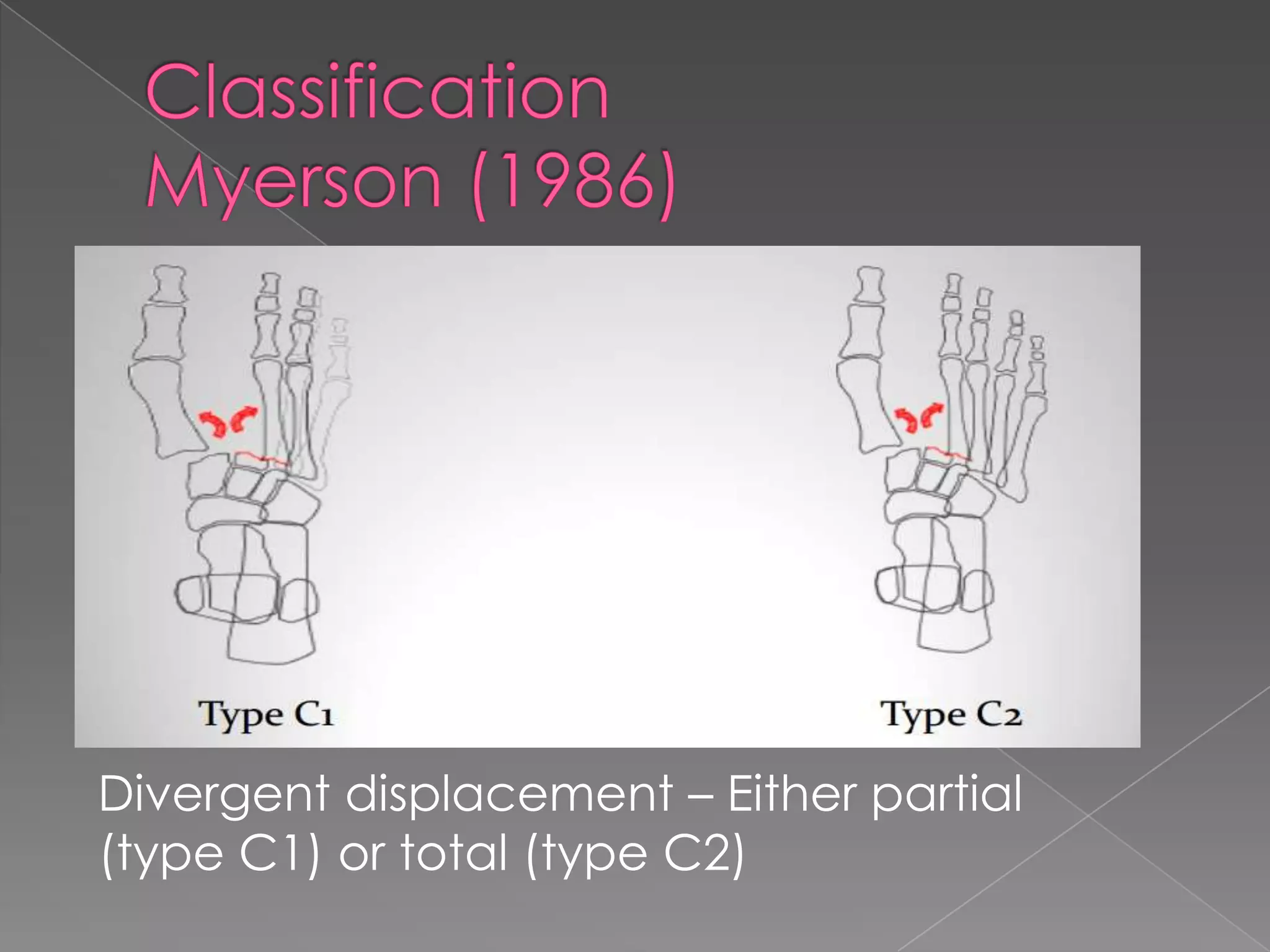 Mid foot lisfranc fracture | PPT