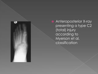 Mid foot lisfranc fracture | PPTX