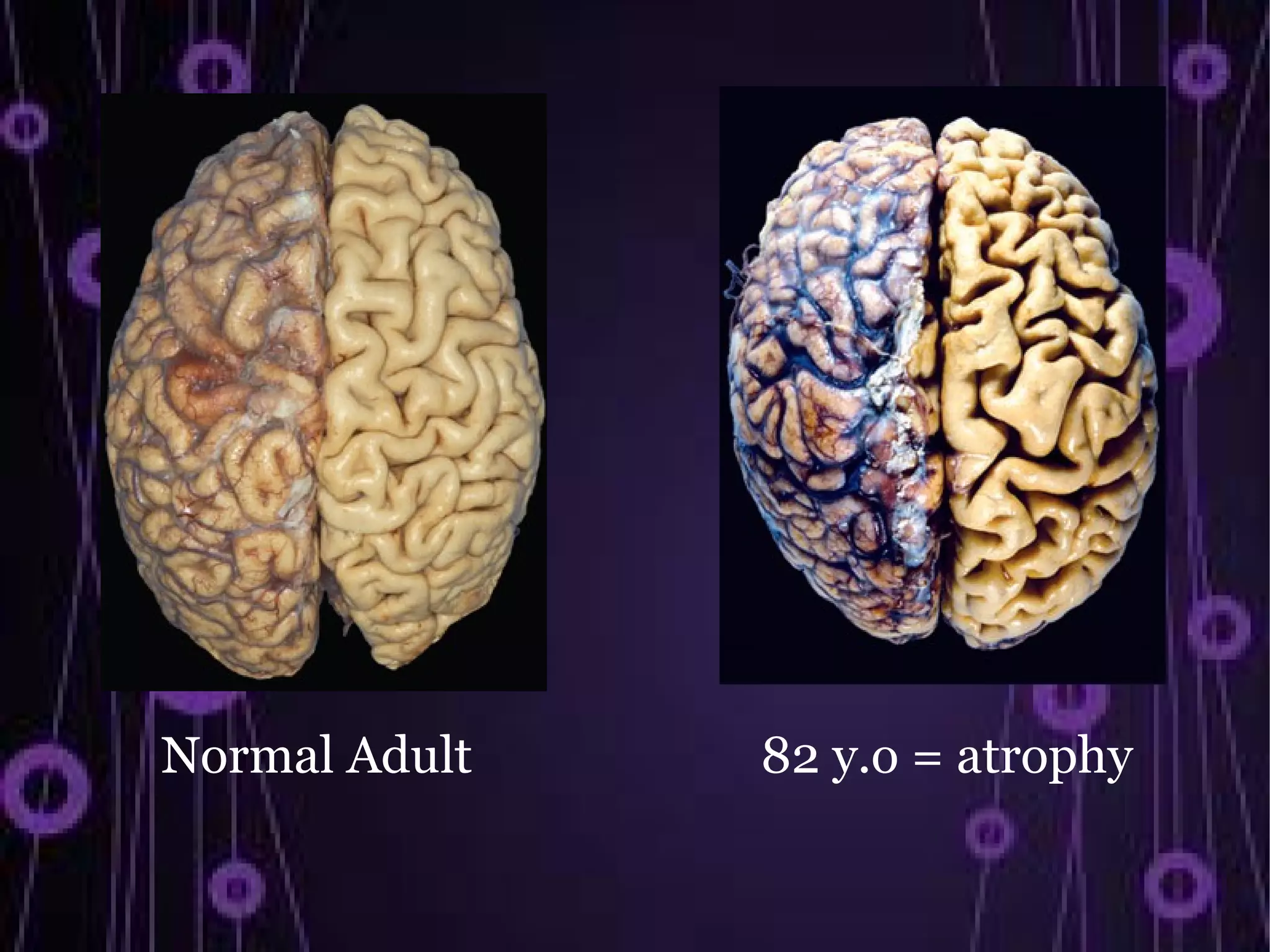 Normal Adult   82 y.o = atrophy
 