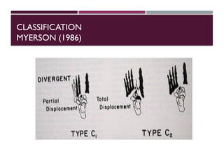 mid and forefoot trauma.power point presentation | PPTX