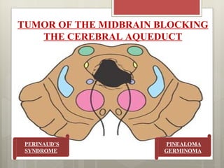 TUMOR OF THE MIDBRAIN BLOCKING
   THE CEREBRAL AQUEDUCT




 PERINAUD’S            PINEALOMA
 SYNDROME              GERMINOMA
 