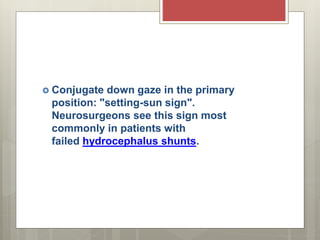 Setting Sun Sign Mechanism clinical anatomy of mid brain | PPTX