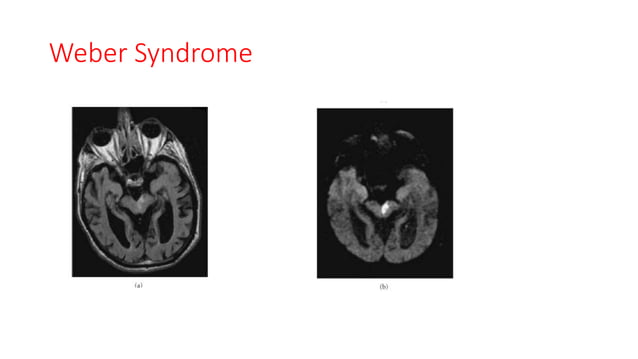 Mid brain anatomy and vascular syndromes | PPTX | Brain and Nervous ...