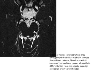 Trochlear nerves (arrows) where they
emerge from the dorsal midbrain to cross
the ambient cisterns. The characteristic
course of the trochlear nerves allows their
differentiation from the nearby superior
cerebellar artery (arrowheads).

 