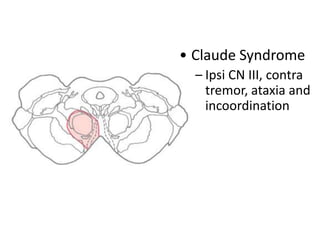 • Claude Syndrome
– Ipsi CN III, contra
tremor, ataxia and
incoordination

 