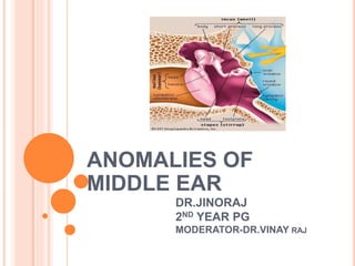 DR.JINORAJ
2ND YEAR PG
MODERATOR-DR.VINAY RAJ
ANOMALIES OF
MIDDLE EAR
 