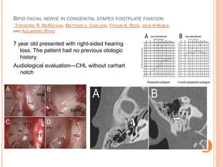 Congenital stapes suprastructure fixation presenting with
