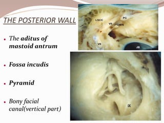 THE POSTERIOR WALL
 The aditus of
mastoid antrum
 Fossa incudis
 Pyramid
 Bony facial
canal(vertical part)
 