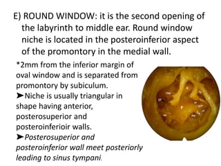 E) ROUND WINDOW: it is the second opening of
the labyrinth to middle ear. Round window
niche is located in the posteroinferior aspect
of the promontory in the medial wall.
*2mm from the inferior margin of
oval window and is separated from
promontory by subiculum.
➤Niche is usually triangular in
shape having anterior,
posterosuperior and
posteroinferioir walls.
➤Posterosuperior and
posteroinferior wall meet posteriorly
leading to sinus tympani.
 