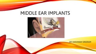 MIDDLE EAR IMPLANTS
DR VAISHNAVI SREERAM
 