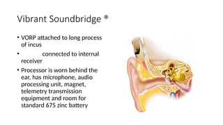 Vibrant Soundbridge ®
• VORP attached to long process
of incus
• connected to internal
receiver
• Processor is worn behind the
ear, has microphone, audio
processing unit, magnet,
telemetry transmission
equipment and room for
standard 675 zinc battery
 