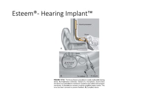Esteem®- Hearing Implant™
 