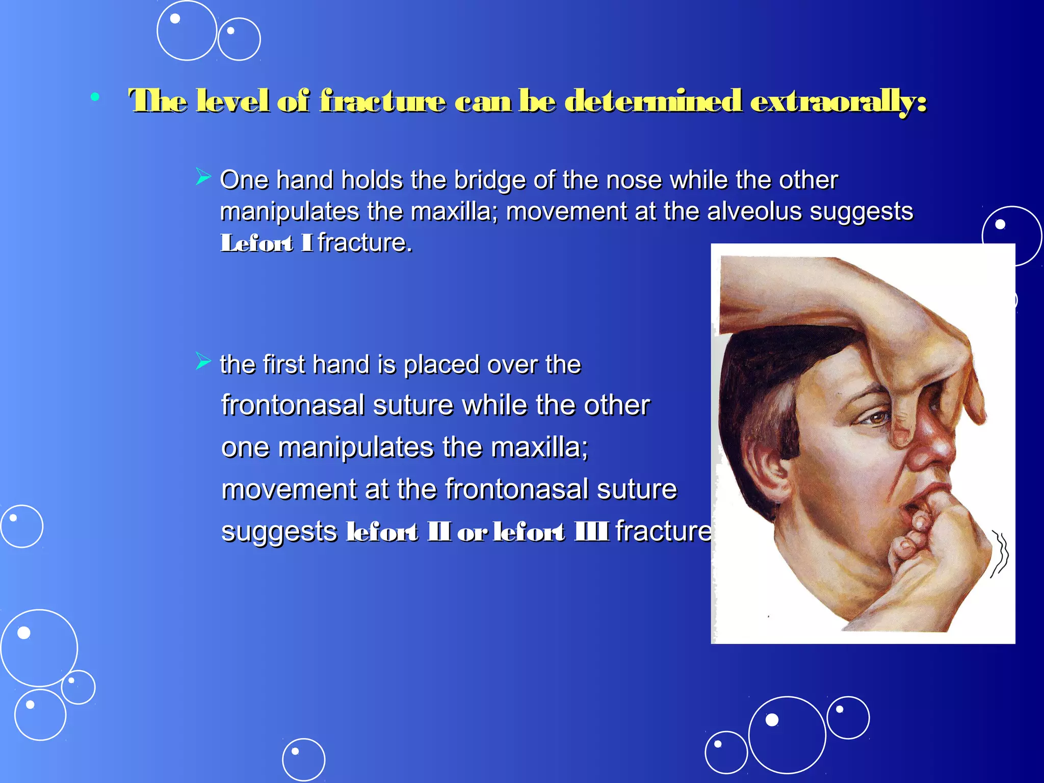 • The level of fracture can be determined extraorally:The level of fracture can be determined extraorally:
 One hand holds the bridge of the nose while the otherOne hand holds the bridge of the nose while the other
manipulates the maxilla; movement at the alveolus suggestsmanipulates the maxilla; movement at the alveolus suggests
Lefort ILefort I fracture.fracture.
 the first hand is placed over thethe first hand is placed over the
frontonasal suture while the otherfrontonasal suture while the other
one manipulates the maxilla;one manipulates the maxilla;
movement at the frontonasal suturemovement at the frontonasal suture
suggestssuggests lefort II orlefort IIIlefort II orlefort III fractures.fractures.
 