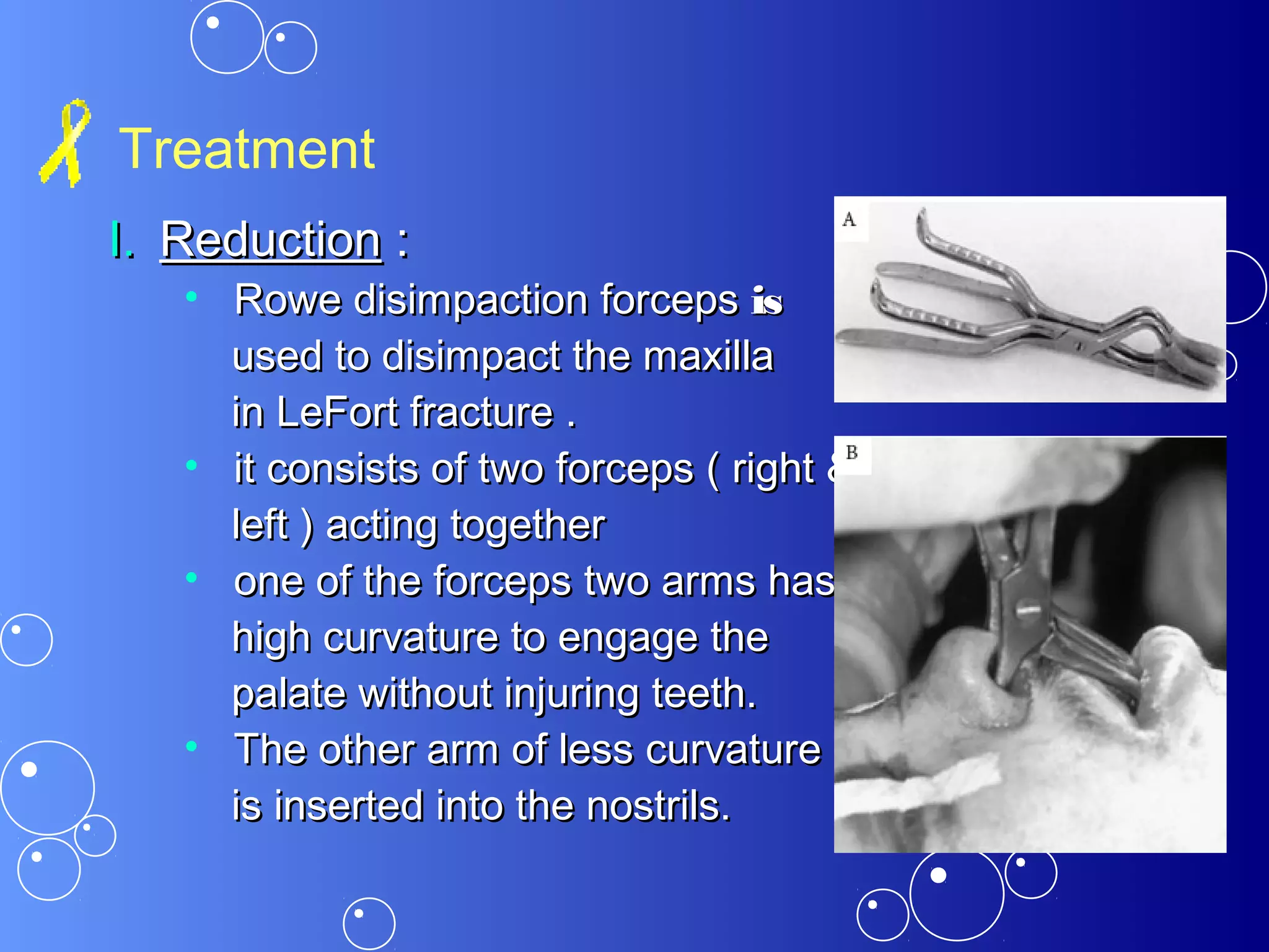 Treatment
I.I. ReductionReduction ::
• Rowe disimpaction forcepsRowe disimpaction forceps isis
used to disimpact the maxillaused to disimpact the maxilla
in LeFort fracture .in LeFort fracture .
• it consists of two forceps ( right &it consists of two forceps ( right &
left ) acting togetherleft ) acting together
• one of the forceps two arms hasone of the forceps two arms has
high curvature to engage thehigh curvature to engage the
palate without injuring teeth.palate without injuring teeth.
• The other arm of less curvatureThe other arm of less curvature
is inserted into the nostrils.is inserted into the nostrils.
 