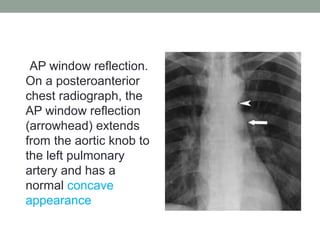 AP window reflection.
On a posteroanterior
chest radiograph, the
AP window reflection
(arrowhead) extends
from the aortic knob to
the left pulmonary
artery and has a
normal concave
appearance
 