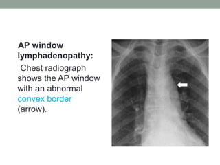 AP window
lymphadenopathy:
Chest radiograph
shows the AP window
with an abnormal
convex border
(arrow).
 