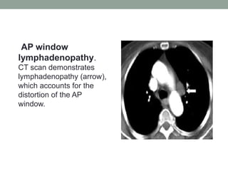 AP window
lymphadenopathy.
CT scan demonstrates
lymphadenopathy (arrow),
which accounts for the
distortion of the AP
window.
 