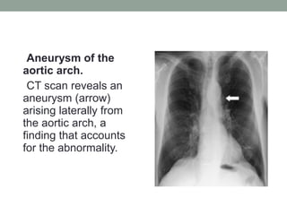 Aneurysm of the
aortic arch.
CT scan reveals an
aneurysm (arrow)
arising laterally from
the aortic arch, a
finding that accounts
for the abnormality.
 