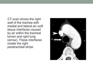 CT scan shows the right
wall of the trachea with
medial and lateral air–soft
tissue interfaces caused
by air within the tracheal
lumen and right lung
(arrow). These interfaces
create the right
paratracheal stripe
 