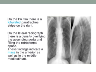 On the PA film there is a
lobulated paratracheal
stripe on the right.
On the lateral radiograph
there is a density overlying
the ascending aorta and
filling the retrosternal
space.
These findings indicate a
mass in the anterior as
well as in the middle
mediastinum.
 