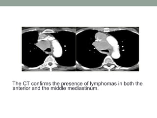 The CT confirms the presence of lymphomas in both the
anterior and the middle mediastinum.
 
