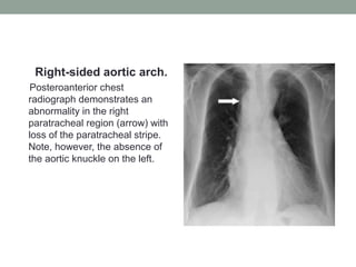 Right-sided aortic arch.
Posteroanterior chest
radiograph demonstrates an
abnormality in the right
paratracheal region (arrow) with
loss of the paratracheal stripe.
Note, however, the absence of
the aortic knuckle on the left.
 