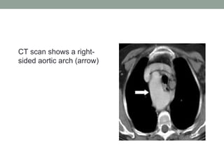 CT scan shows a right-
sided aortic arch (arrow)
 