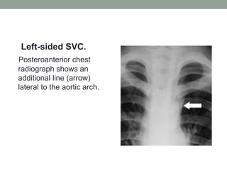 Left-sided SVC.
Posteroanterior chest
radiograph shows an
additional line (arrow)
lateral to the aortic arch.
 