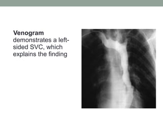 Venogram
demonstrates a left-
sided SVC, which
explains the finding
 