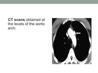 CT scans obtained at
the levels of the aortic
arch.
 