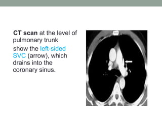 CT scan at the level of
pulmonary trunk
show the left-sided
SVC (arrow), which
drains into the
coronary sinus.
 