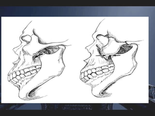 Middle third fractures | PPSX