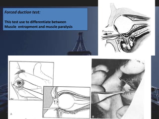 Middle third fractures | PPSX