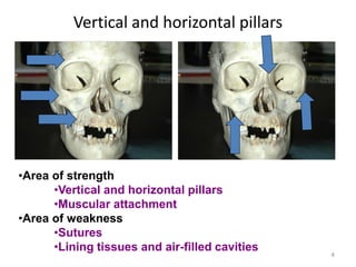 Vertical and horizontal pillars
4
•Area of strength
•Vertical and horizontal pillars
•Muscular attachment
•Area of weakness
•Sutures
•Lining tissues and air-filled cavities
 