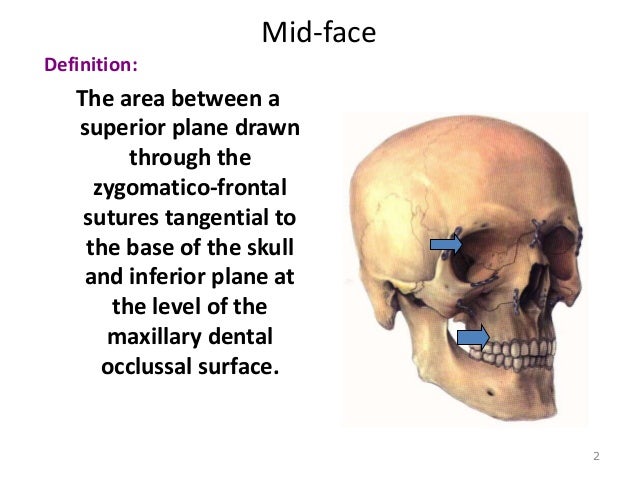 Mid face trauma
