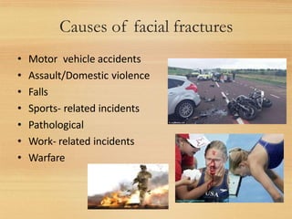 Causes of facial fractures
11
• Motor vehicle accidents
• Assault/Domestic violence
• Falls
• Sports- related incidents
• Pathological
• Work- related incidents
• Warfare
 