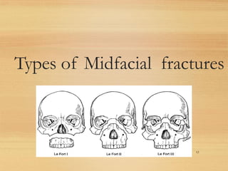 Types of Midfacial fractures
12
 