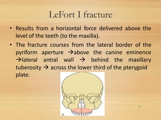 LeFort I fracture
17
• Results from a horizontal force delivered above the
level of the teeth (to the maxilla).
• The fracture courses from the lateral border of the
pyriform aperture →above the canine
→lateral antral wall → behind the
eminence
maxillary
tuberosity → across the lower third of the pterygoid
plate.
 