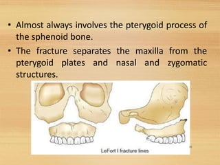 • Almost always involves the pterygoid process of
the sphenoid bone.
• The fracture separates the maxilla from the
pterygoid plates and nasal and zygomatic
structures.
18
 