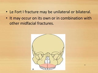 • Le Fort I fracture may be unilateral or bilateral.
• It may occur on its own or in combination with
other midfacial fractures.
20
 