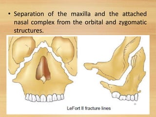 • Separation of the maxilla and the attached
nasal complex from the orbital and zygomatic
structures.
23
 