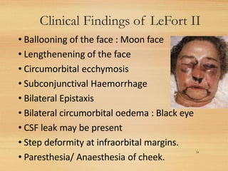 Clinical Findings of LeFort II
24
• Ballooning of the face : Moon face
• Lengthenening of the face
• Circumorbital ecchymosis
• Subconjunctival Haemorrhage
• Bilateral Epistaxis
• Bilateral circumorbital oedema : Black eye
• CSF leak may be present
• Step deformity at infraorbital margins.
• Paresthesia/ Anaesthesia of cheek.
 