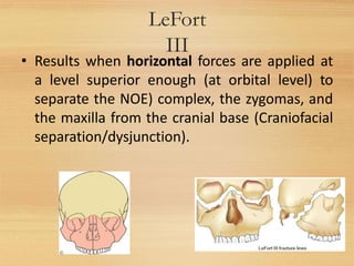 LeFort
III
25
• Results when horizontal forces are applied at
a level superior enough (at orbital level) to
separate the NOE) complex, the zygomas, and
the maxilla from the cranial base (Craniofacial
separation/dysjunction).
 