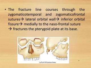 • The fracture line courses through the
zygomaticotemporal and zygomaticofrontal
sutures→ lateral orbital wall→ inferior orbital
fissure→ medially to the naso-frontal suture
→ fractures the pterygoid plate at its base.
26
 