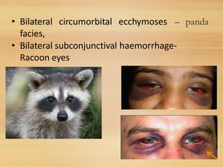 • Bilateral circumorbital ecchymoses
facies,
• Bilateral subconjunctival haemorrhage-
Racoon eyes
– panda
28
 