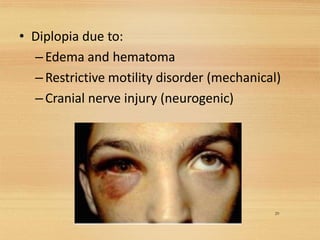 • Diplopia due to:
–Edema and hematoma
–Restrictive motility disorder (mechanical)
–Cranial nerve injury (neurogenic)
29
 