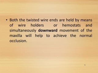 36
• Both the twisted wire ends are held by means
of wire holders or hemostats and
simultaneously downward movement of the
maxilla will help to achieve the normal
occlusion.
 